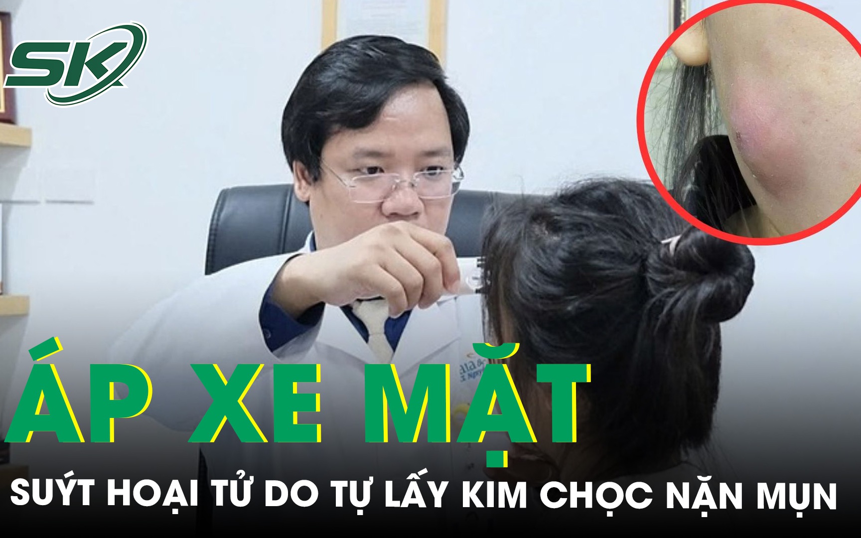 Tự lấy kim chọc mụn rồi dùng tay nặn cô gái trẻ suýt hoại tử mặt