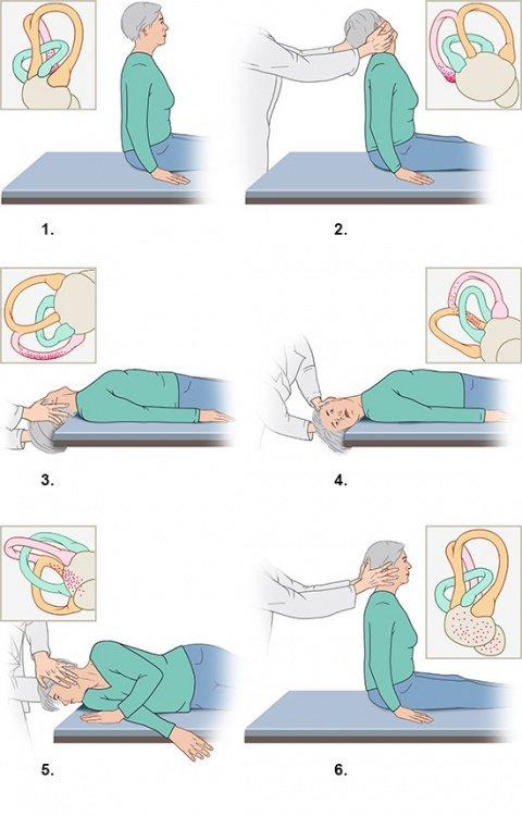 Bài tập cho người chóng mặt kịch phát lành tính- Ảnh 2.