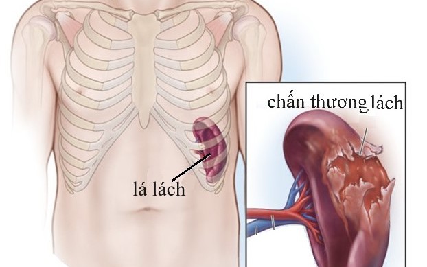 Thuốc và các phương pháp điều trị chấn thương lách