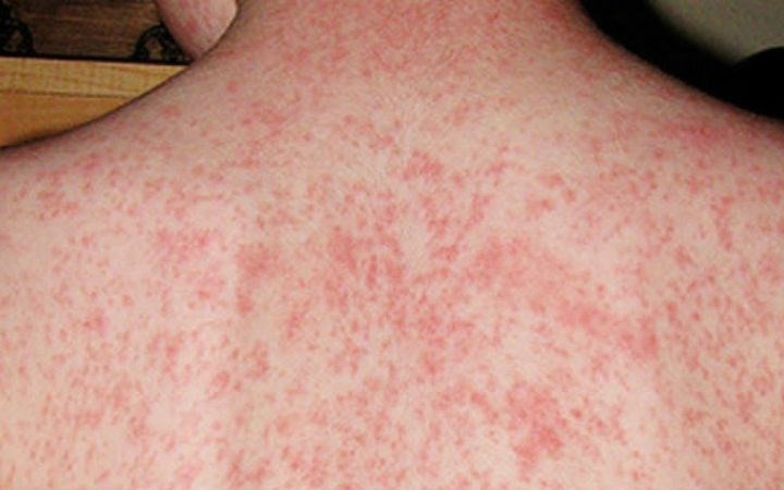 Bệnh sởi và cách phòng tránh