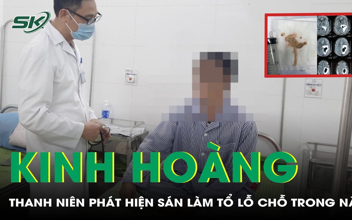 Tưởng u não, thanh niên đi khám bàng hoàng phát hiện sán làm tổ lỗ chỗ trong não