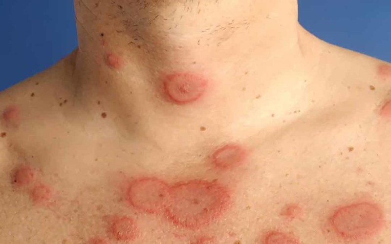 Biểu hiện của lupus ban đỏ như thế nào?