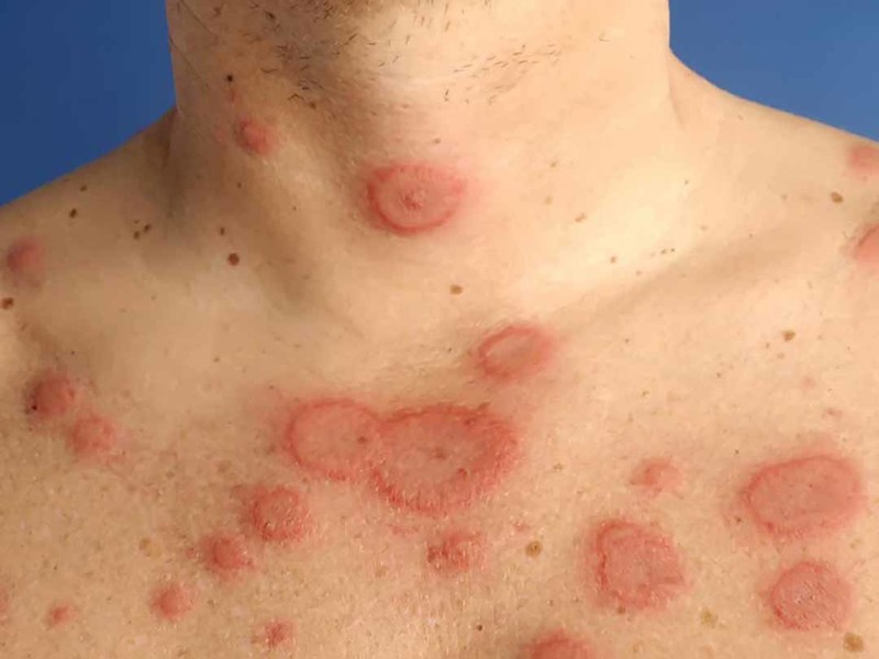 Biểu hiện của lupus ban đỏ như thế nào?- Ảnh 1.