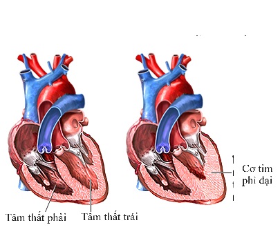 Các thuốc điều trị bệnh cơ tim phì đại- Ảnh 2.