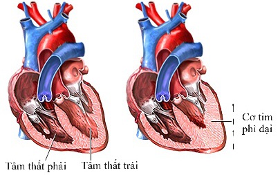 Các thuốc điều trị bệnh cơ tim phì đại