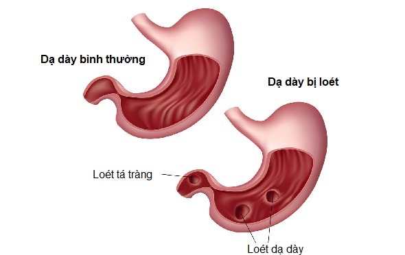 Bài tập cho người bệnh loét dạ dày tá tràng- Ảnh 1.