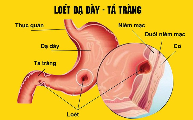 Loét dạ dày tá tràng: Nguyên nhân, triệu chứng, phòng ngừa và cách điều trị