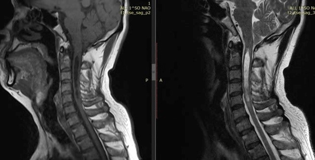 Bệnh viện HNĐK Nghệ An điều trị thành công bệnh nhân mắc hội chứng Arnold chiari hiếm gặp- Ảnh 2.