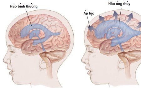 Các phương pháp điều trị não úng thủy