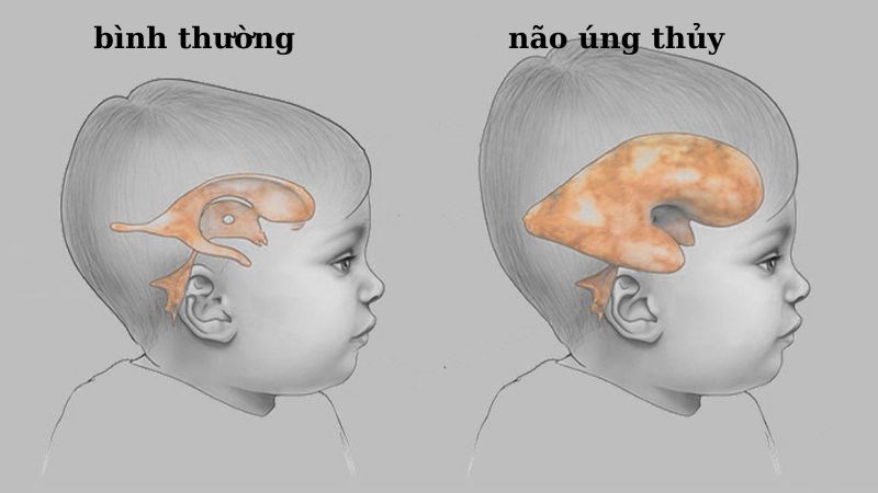 Phát hiện sớm não úng thủy ở trẻ nhỏ- Ảnh 1.