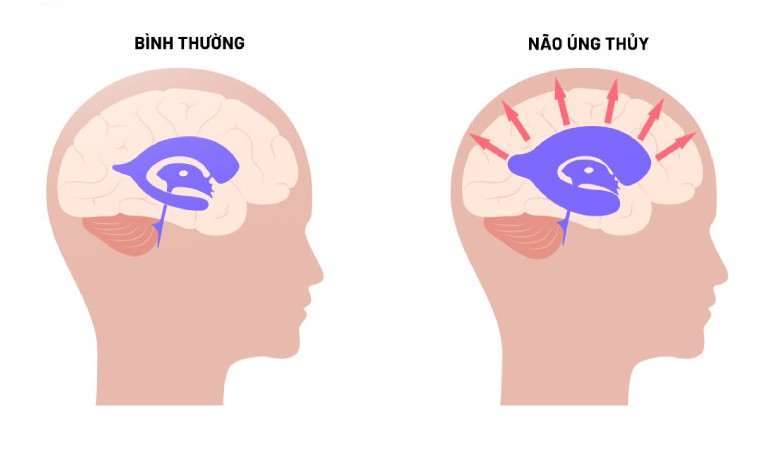 Não úng thủy: Nguyên nhân, triệu chứng, phòng ngừa và cách điều trị