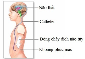 Các phương pháp điều trị não úng thủy- Ảnh 1.