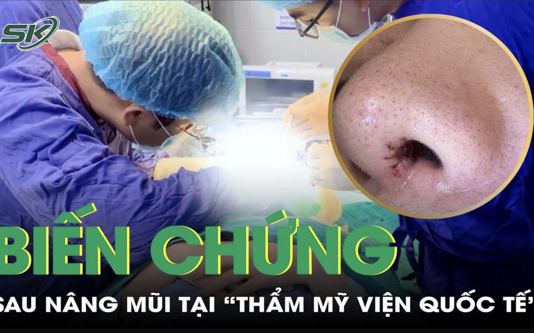 Mũi chảy dịch, biến chứng sau khi nâng mũi tại "thẩm mỹ viện quốc tế"