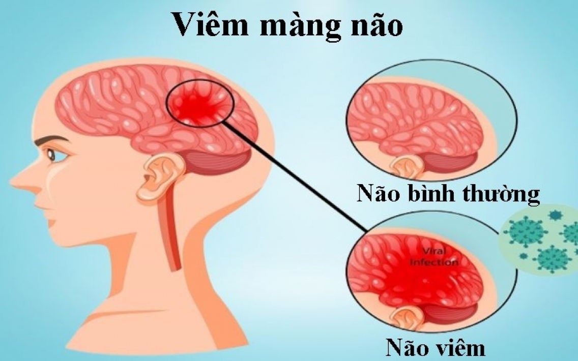 Thuốc điều trị viêm màng não mủ