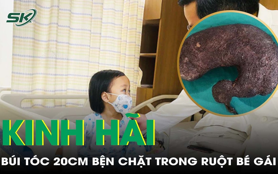 Sụt 8kg do nhiễm 5 loại giun sán vì thói quen thích ăn rau sống 