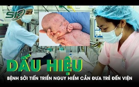 Dấu hiệu bệnh sởi tiến triển nguy hiểm cha mẹ cần đưa trẻ đến viện ngay