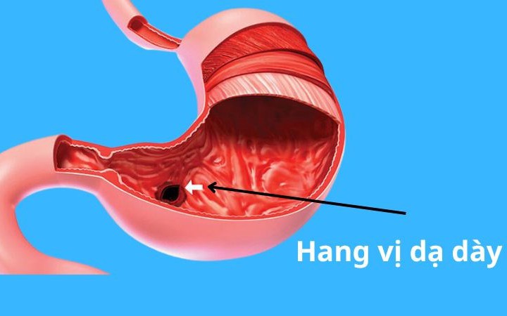 Viêm niêm mạc hang vị dạ dày: Nguyên nhân, triệu chứng, cách điều trị và phòng ngừa