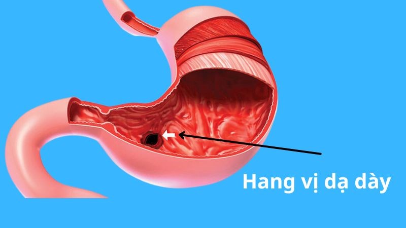 Điều trị viêm hang vị dạ dày: Giải pháp hiệu quả và an toàn