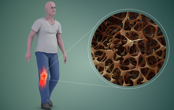 4. Các yếu tố nguy cơ và nguyên nhân dẫn đến loãng xương