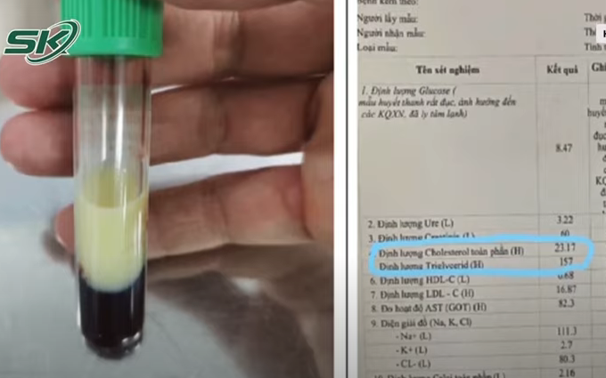 Đau bụng dữ dội, nguy kịch vì chỉ số mỡ máu cao gấp 50 lần người bình thường