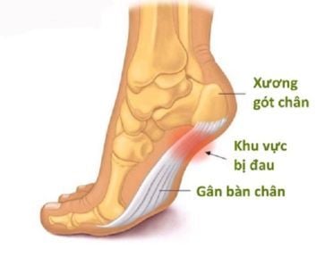 Các loại thuốc điều trị viêm cân gan chân- Ảnh 1.