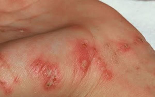 Những bệnh về da thường gặp trong mùa mưa lũ