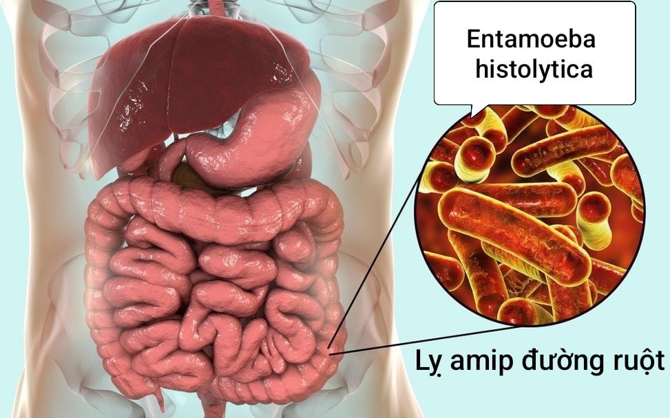 Lỵ amip đường ruột: Nguyên nhân, triệu chứng, điều trị và các biện pháp phòng ngừa