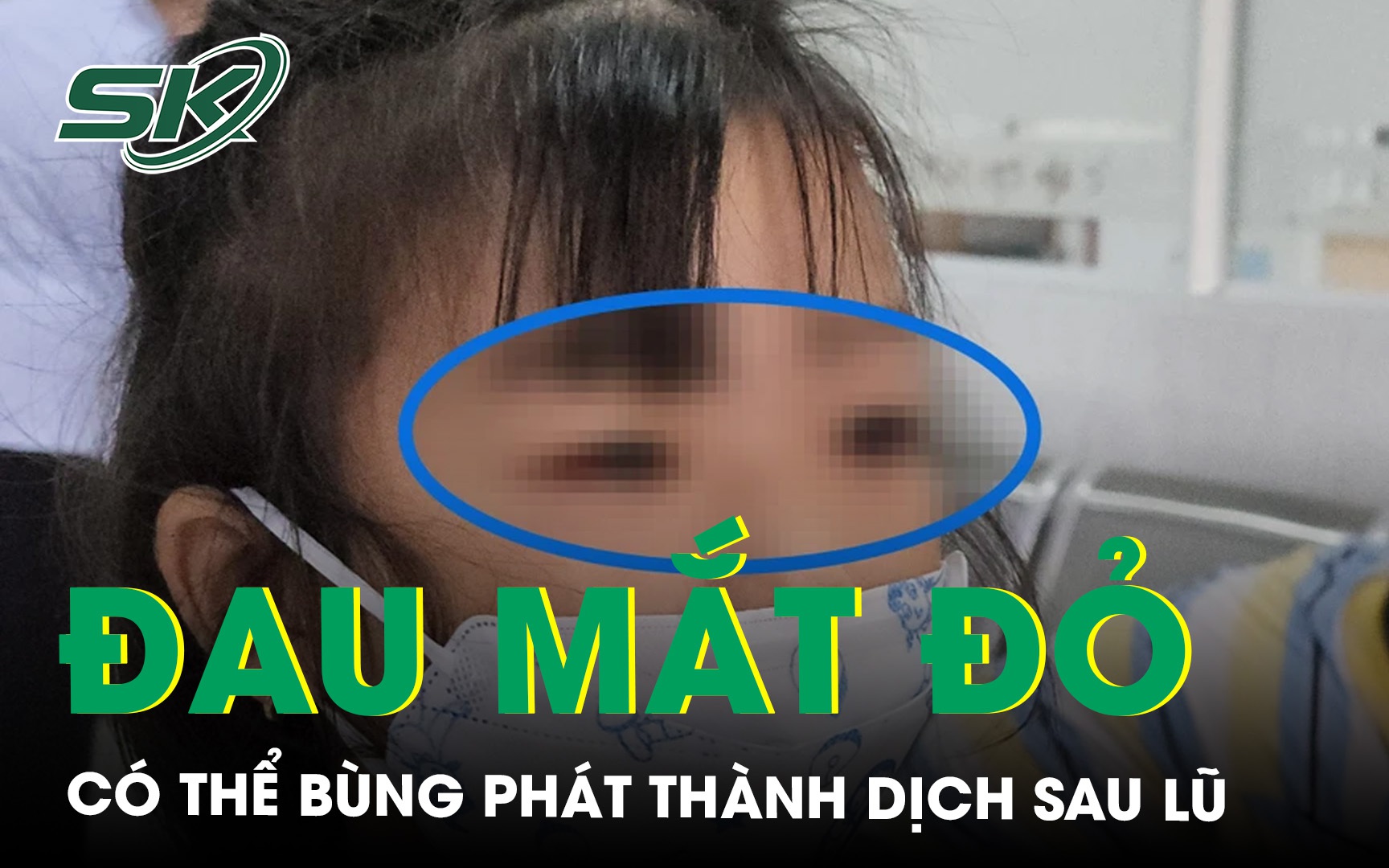 Cảnh báo: Bệnh đau mắt đỏ có thể bùng phát thành dịch sau lũ 