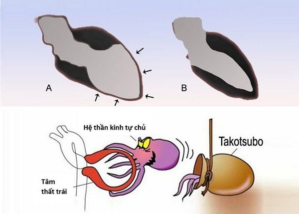 Điều gì xảy ra với trái tim khi bạn thất tình?- Ảnh 1.