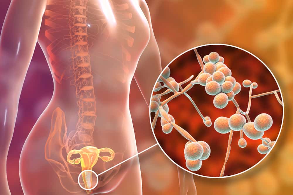 Bệnh nấm Candida: Nguyên nhân, triệu chứng, điều trị và cách phòng ngừa- Ảnh 3.