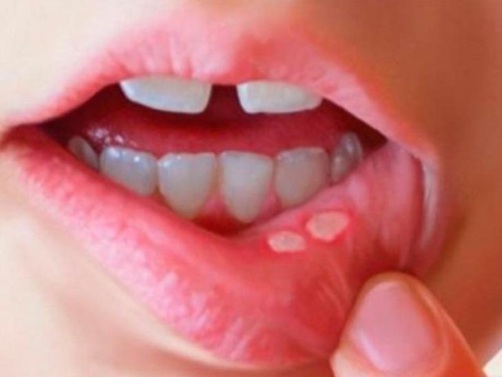 Lưu ý đặc biệt khi bị nhiệt miệng- Ảnh 1.