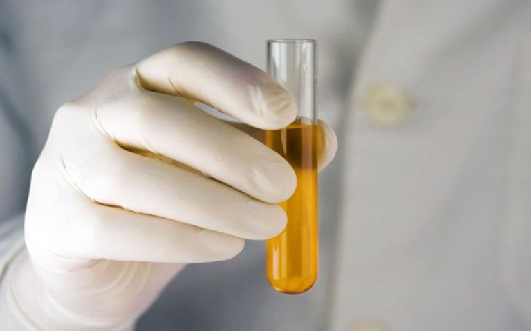 Nước tiểu sẫm màu do nguyên nhân gì?