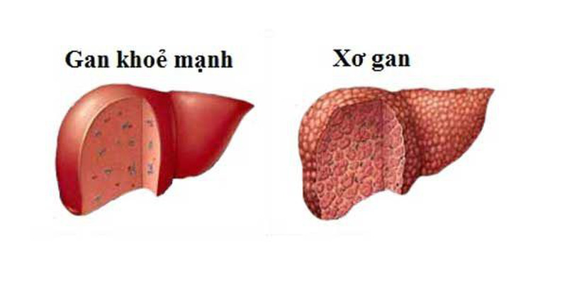 Người bệnh gan nên tập thể dục như thế nào?- Ảnh 2.