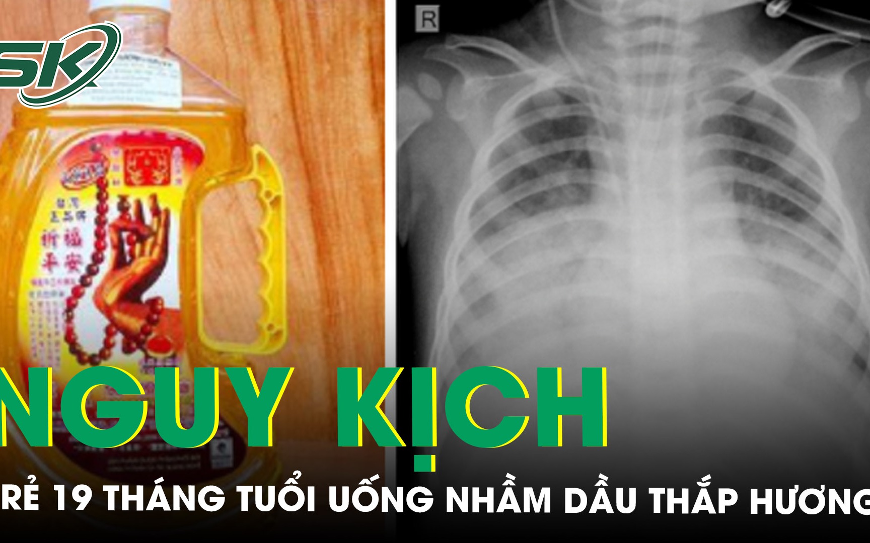 Trẻ 19 tháng tuổi nguy kịch khi uống nhầm dầu thắp hương