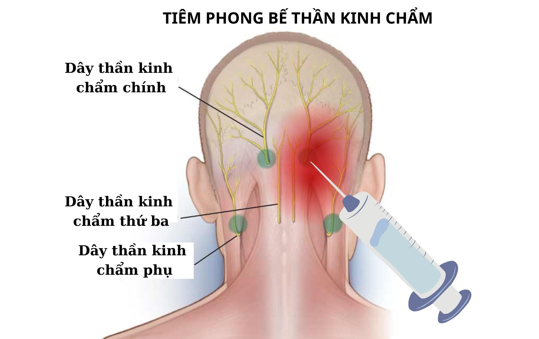 Các biện pháp điều trị đau dây thần kinh chẩm- Ảnh 4.