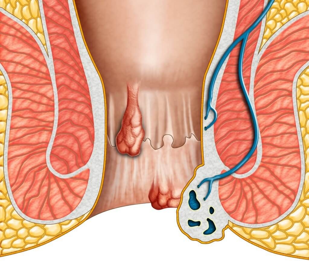 Cách chữa bệnh trĩ tại nhà hiệu quả- Ảnh 1.