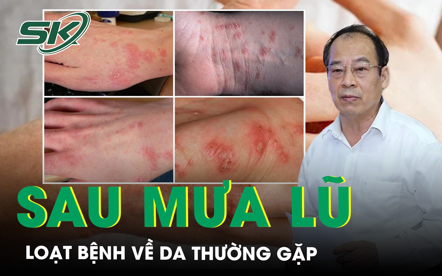 Loạt bệnh về da thường gặp sau mùa mưa lũ cần đặc biệt lưu ý