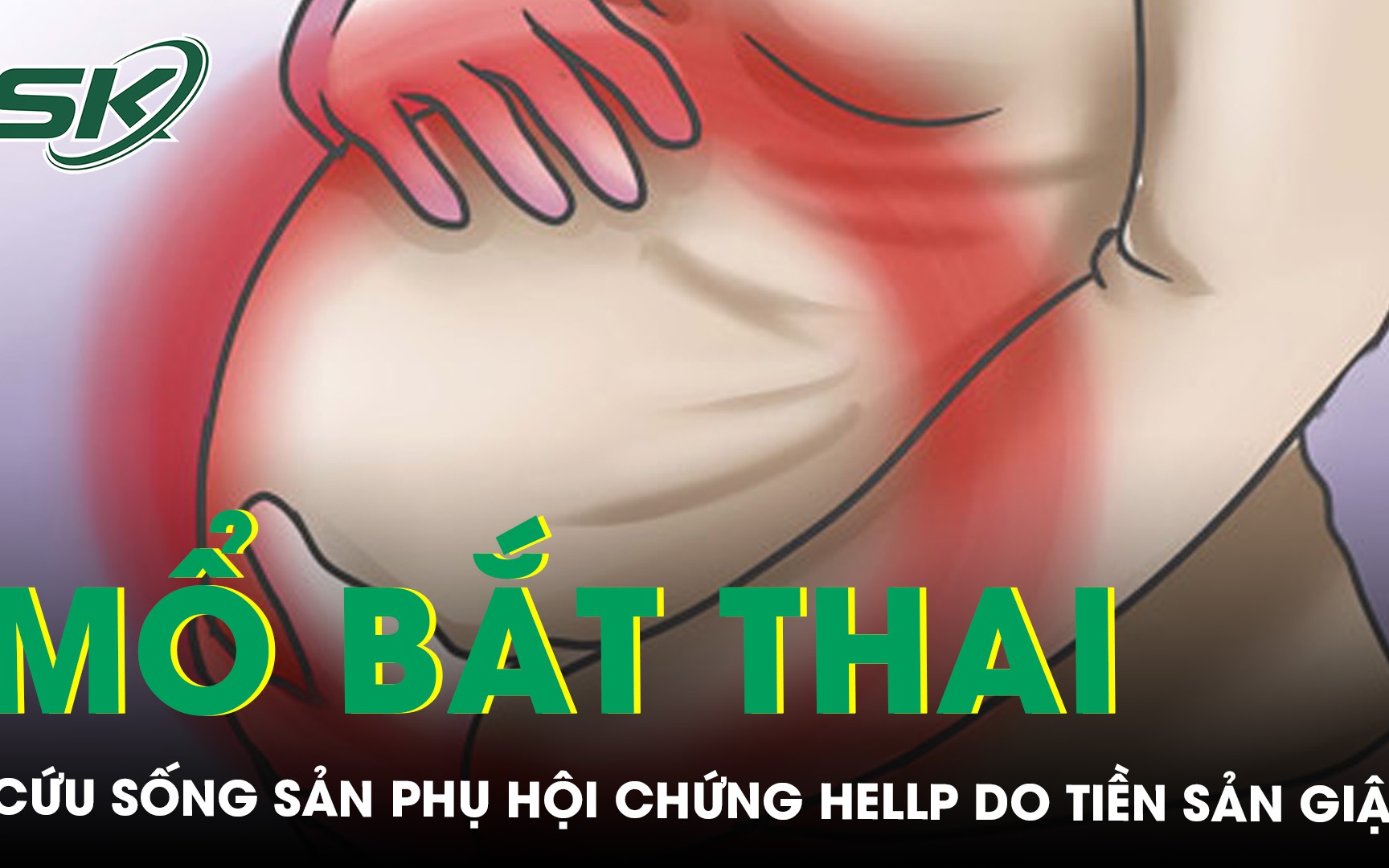 Mổ bắt thai cứu sản phụ hội chứng HELLP tiền sản giật nặng