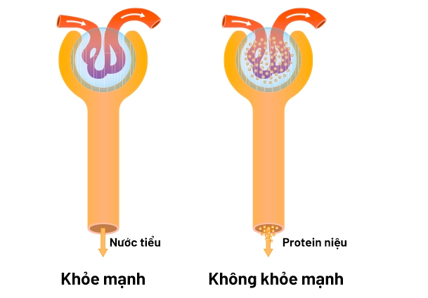 Đạm niệu: Nguyên nhân, biểu hiện, cách điều trị và phòng bệnh- Ảnh 2.