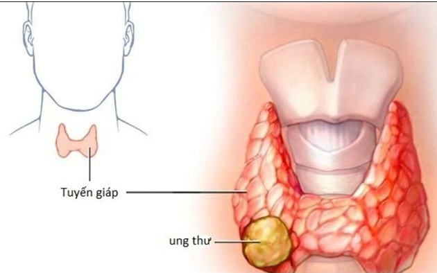 Các dấu hiệu điển hình của ung thư tuyến giáp ai cũng cần biết