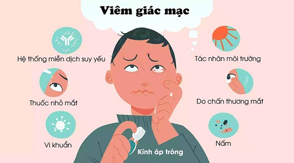 Câu hỏi liên quan đến bệnh loét giác mạc- Ảnh 2.