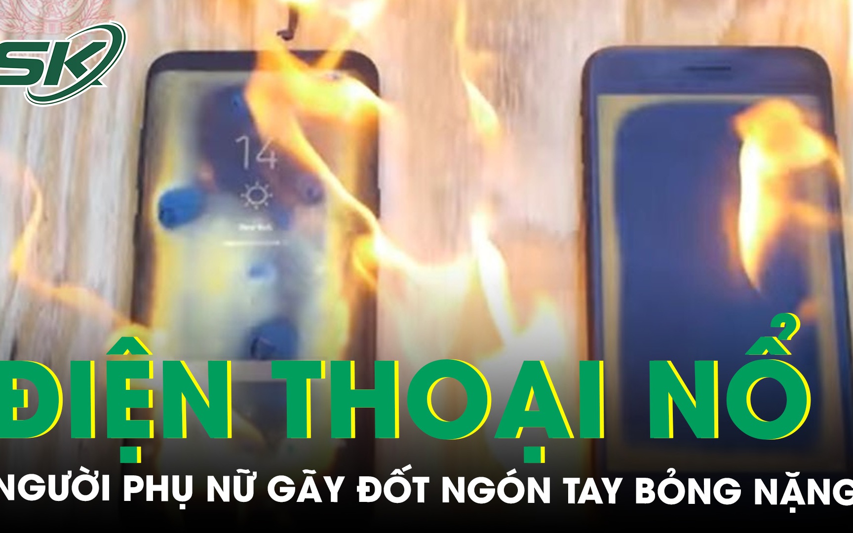 Gãy đốt ngón tay, bỏng nặng do điện thoại phát nổ 