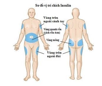 1. Tác dụng phụ thường gặp khi tiêm insulin