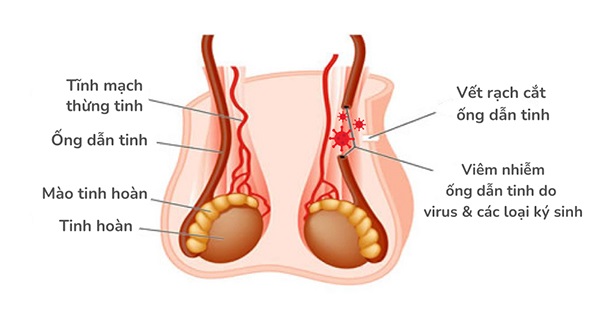 Viêm tắc ống dẫn tinh: Nguyên nhân, triệu chứng, các biện pháp điều trị và phòng ngừa- Ảnh 1.