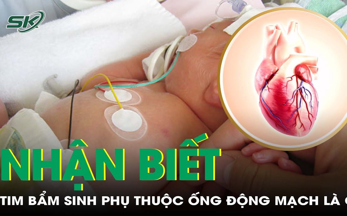 Bệnh tim bẩm sinh phụ thuộc ống động mạch là gì?