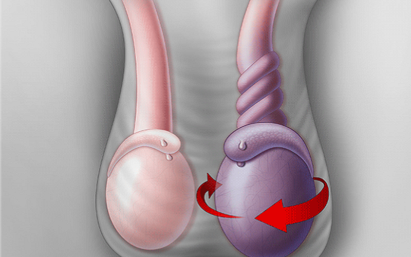 Xoắn tinh hoàn cần cấp cứu sớm trong 6 giờ đầu, tránh nguy cơ bị hoại tử