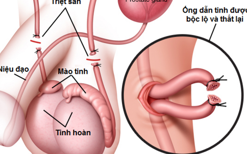 Thắt ống dẫn tinh có gây vô sinh và yếu sinh lý?