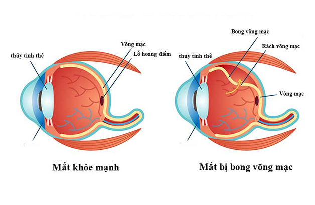 Bệnh rách võng mạc mắt: Nguyên nhân, triệu chứng, phòng bệnh và điều trị- Ảnh 1.