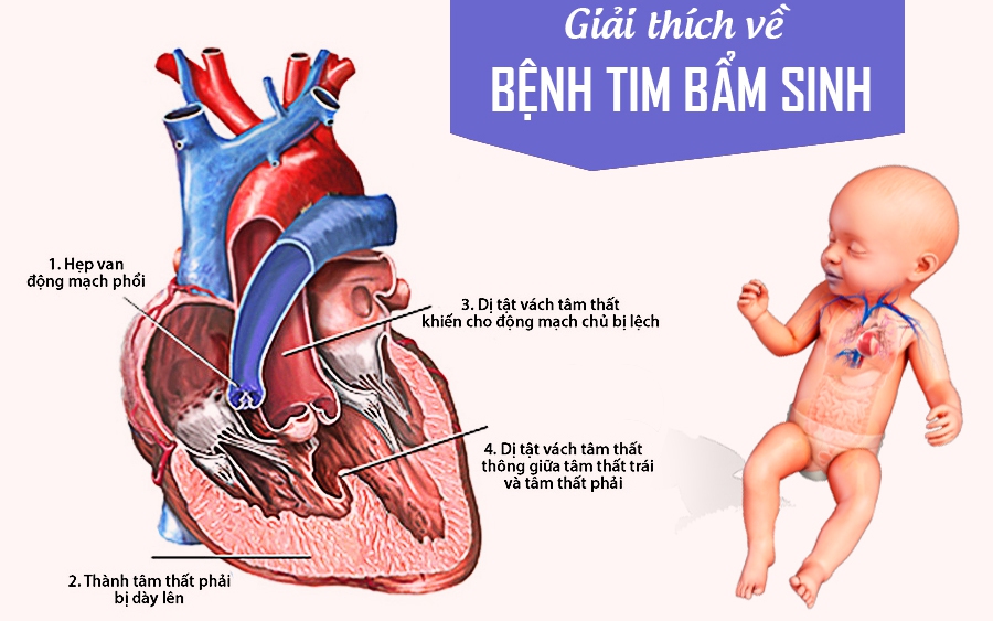 Tim bẩm sinh: Nguyên nhân, triệu chứng, phương pháp điều trị