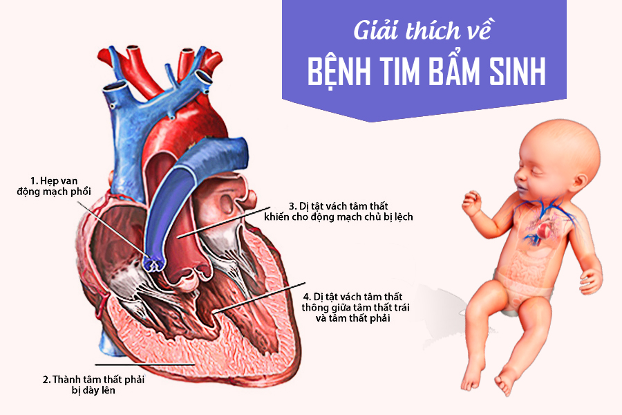 Tim bẩm sinh: Nguyên nhân, triệu chứng, phương pháp điều trị- Ảnh 1.